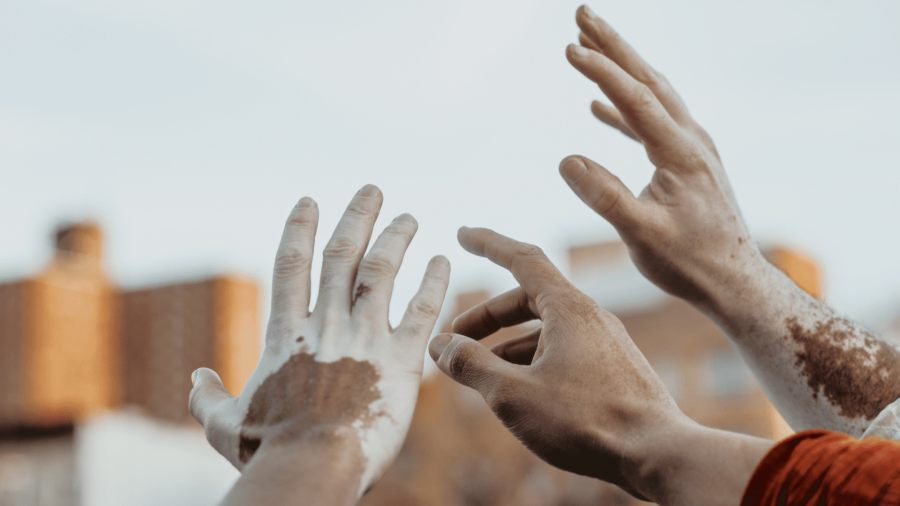 Vitiligo: What We Know and What We Don’t Know